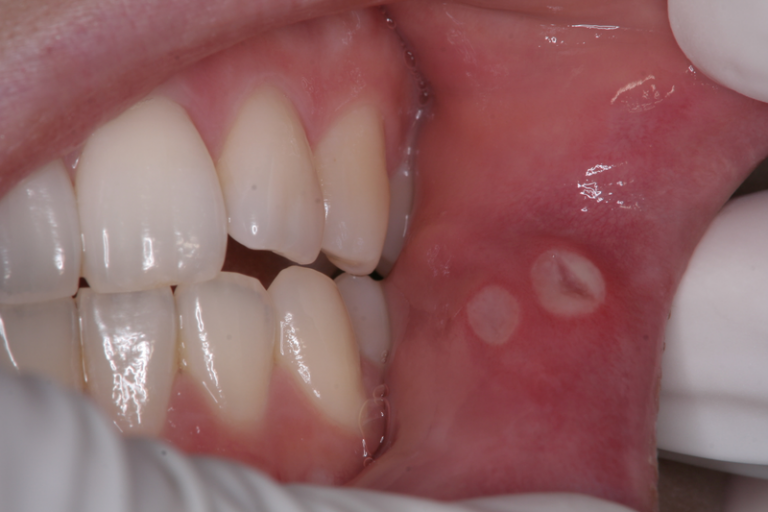 歯茎 の 奥 口内炎